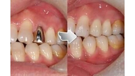 銀歯除去後に白い被せもの（ジルコニアクラウン）をした施術 | コージ歯科 | ホットペッパービューティー