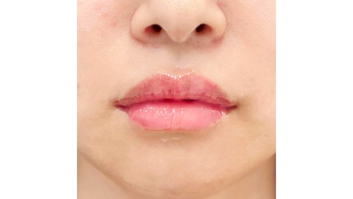ナチュラルに口角上向き 可愛い唇のデザインならお任せください スマイルリップです 代女性 エークリニック 横浜院 Aclinic ホットペッパービューティー