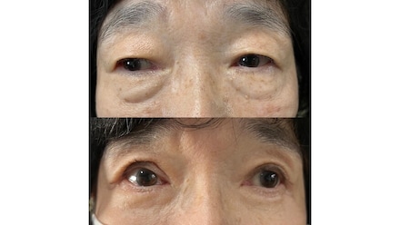 症例写真 (眼瞼下垂手術/ハムラ法・裏ハムラ法)